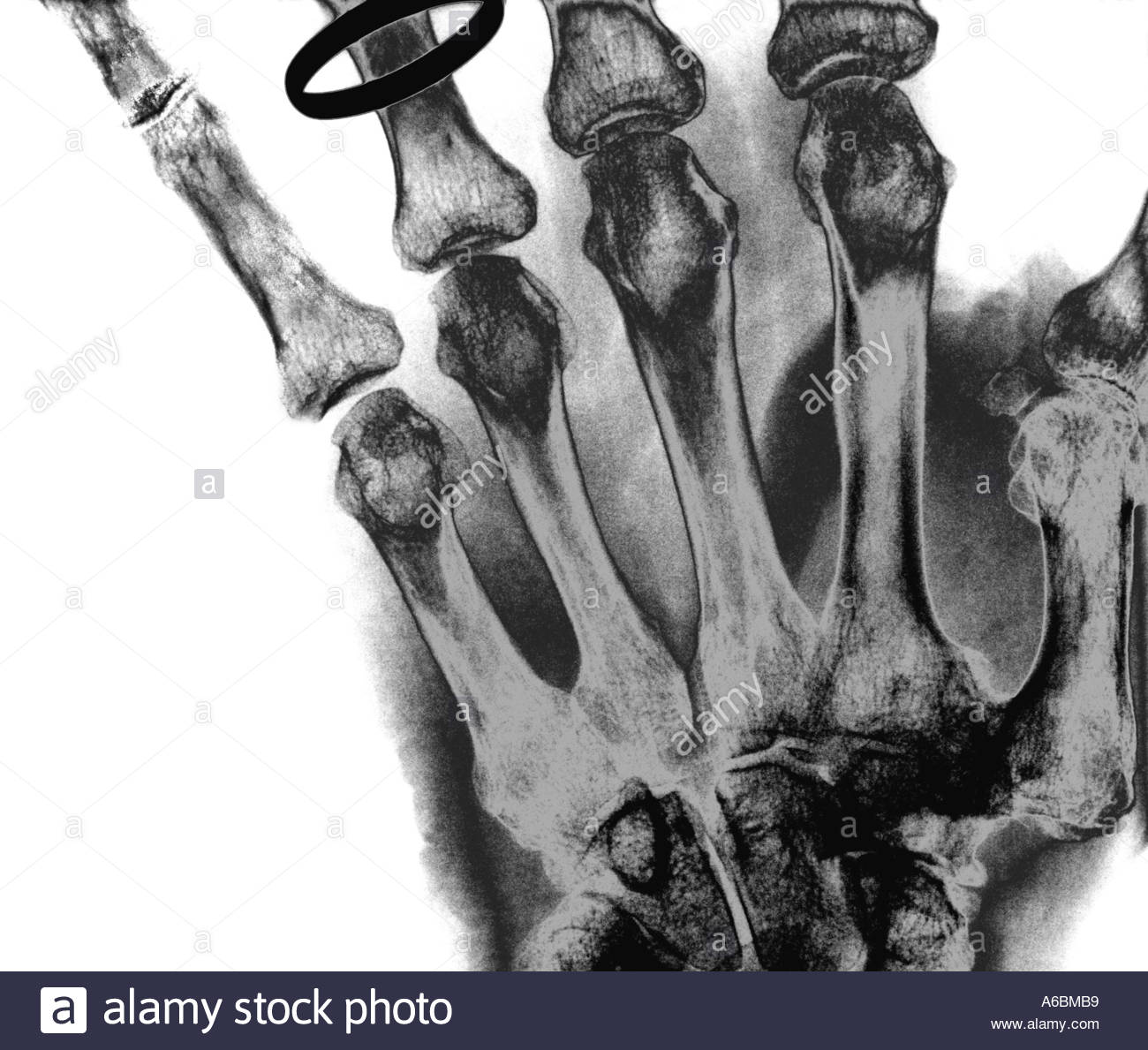 Hand X Ray Ring High Resolution Stock Photography and Images Alamy