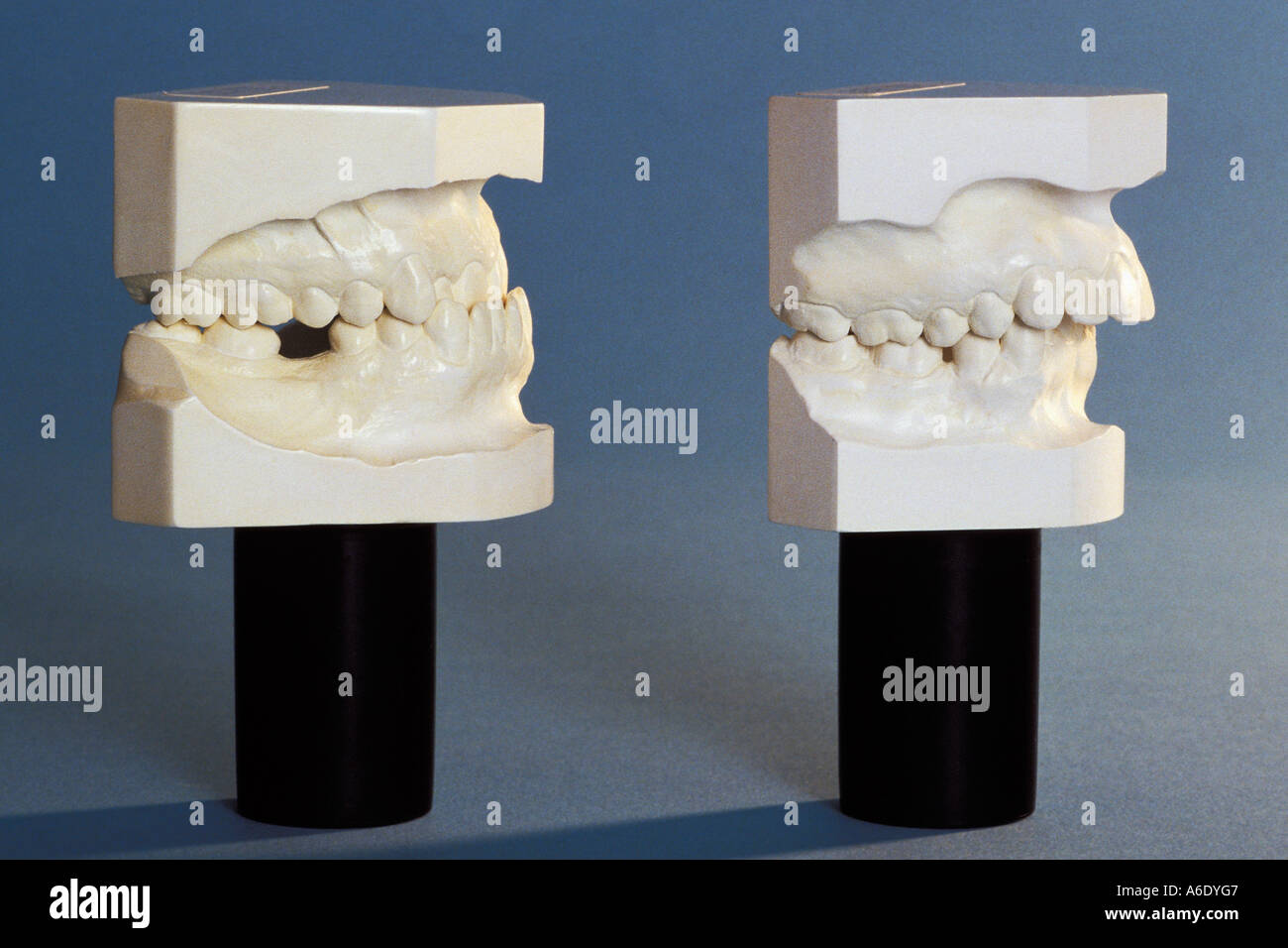 Plaster of paris casts of upper and lower jaw show example of under bite and overbite of teeth