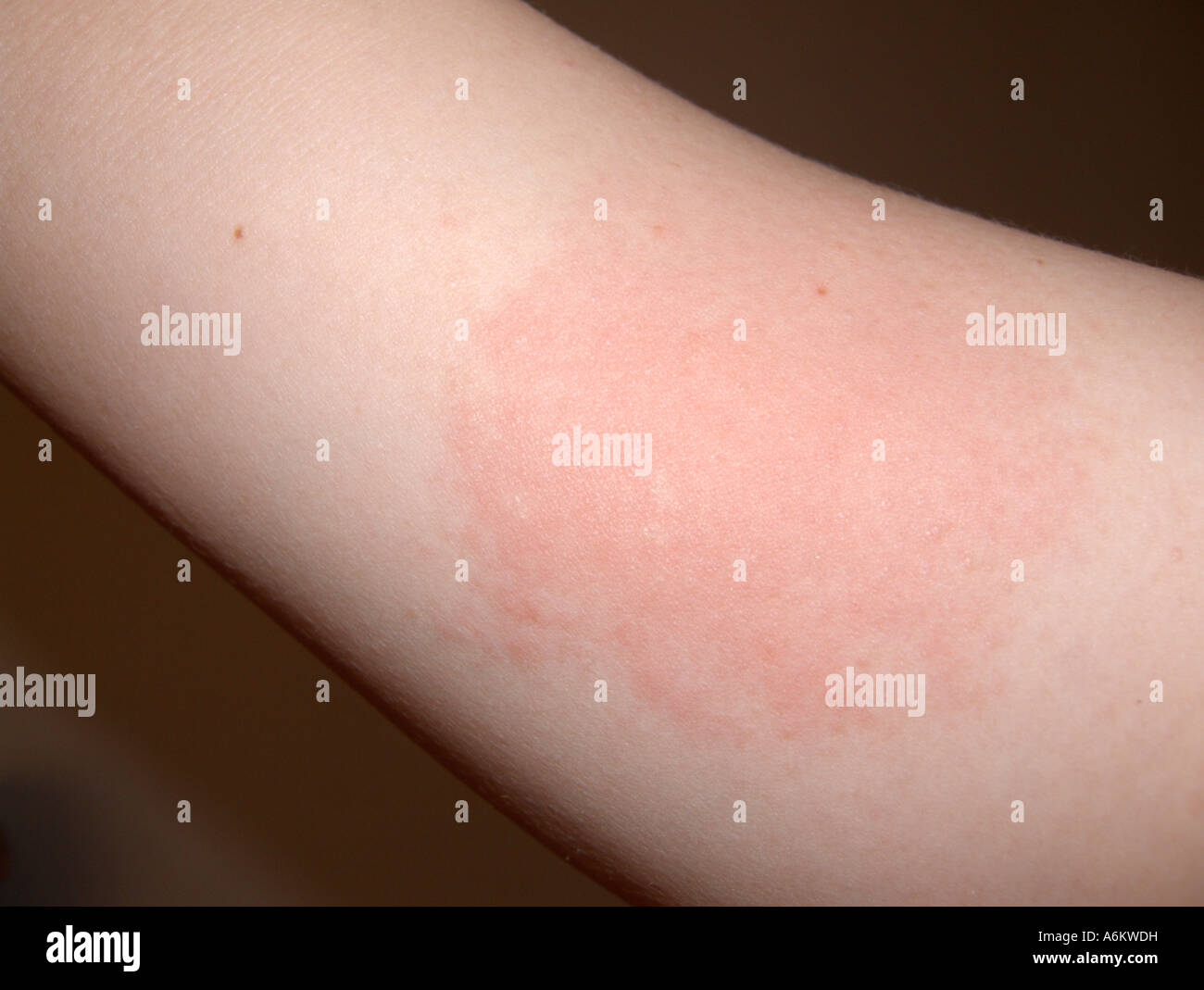 Skin Rash High Resolution Stock Photography And Images Alamy