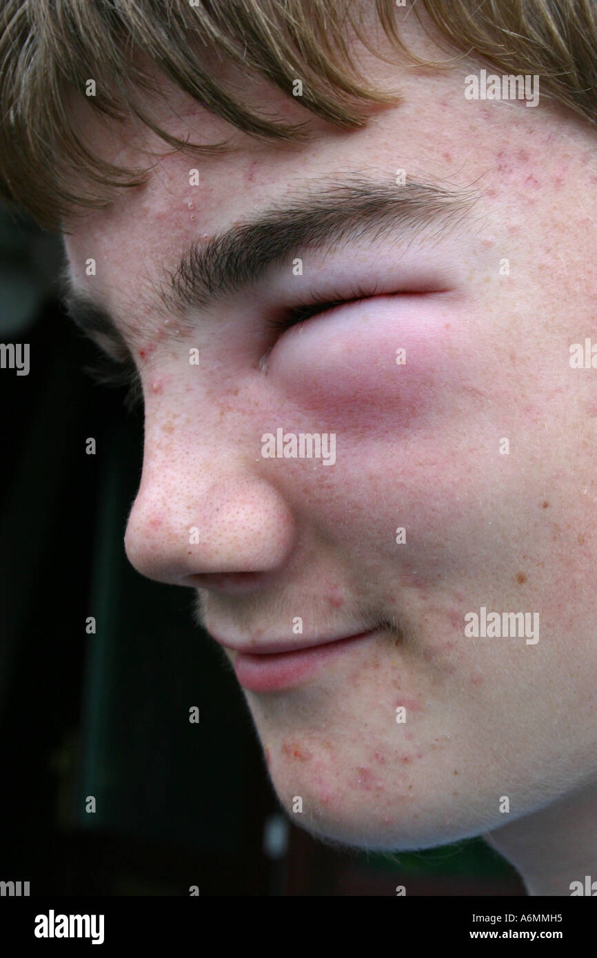 Inflamed Eye Stock Photos Images Alamy Spotty Teenage Boy With Very Swollen Eye Ca By Wasp Sting Stock Image