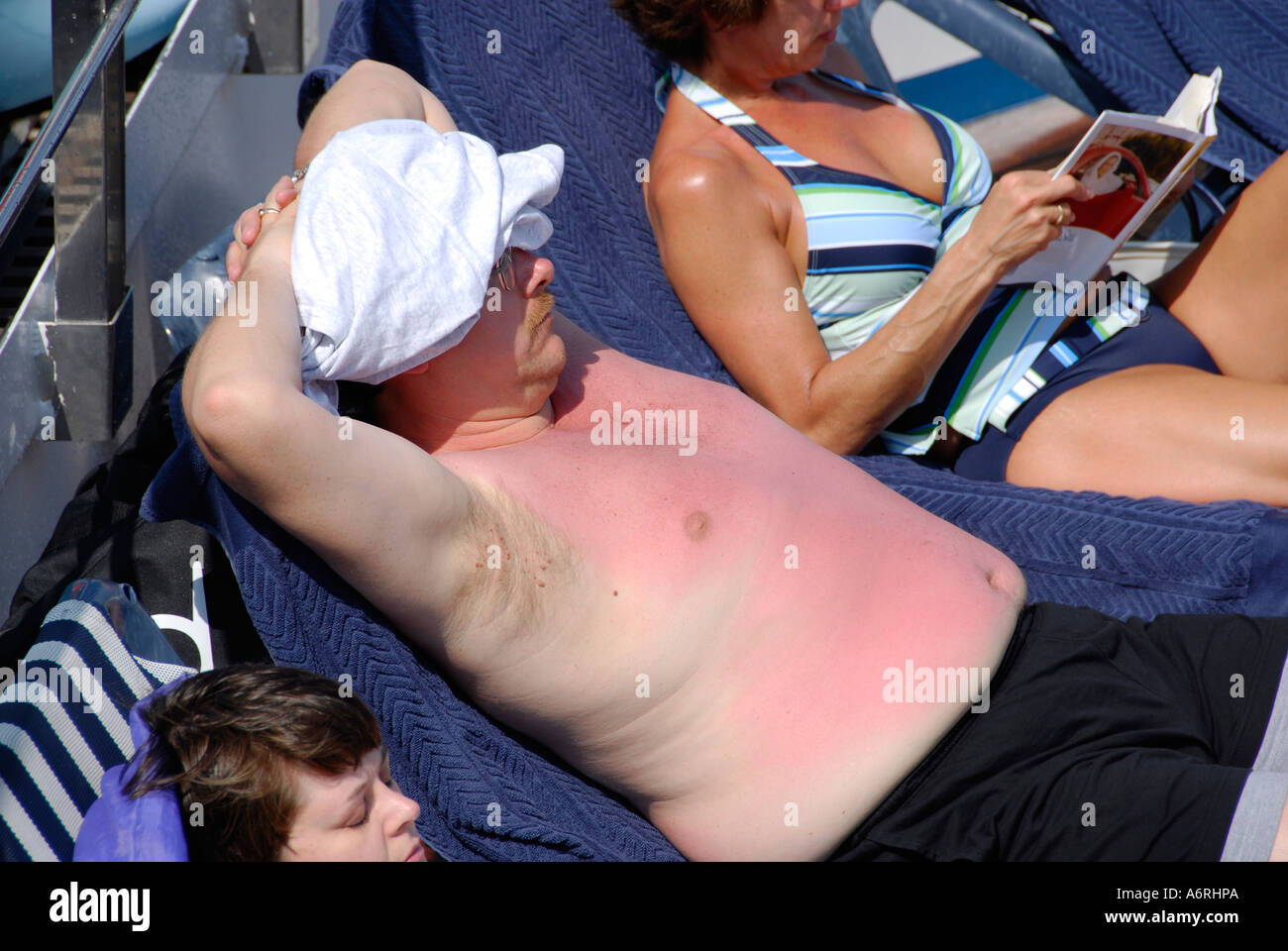 Sun burn from ultra violet uv rays is the result from too much exposure Stock Photo