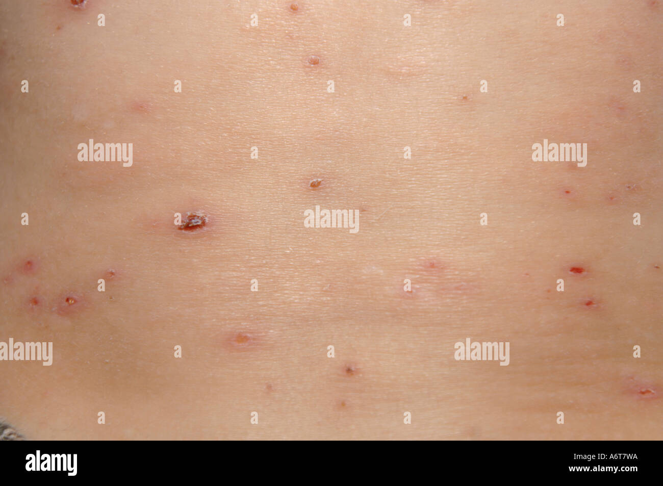 Dan Burton Adventurer Chicken Pox Children Measles Stock Photos