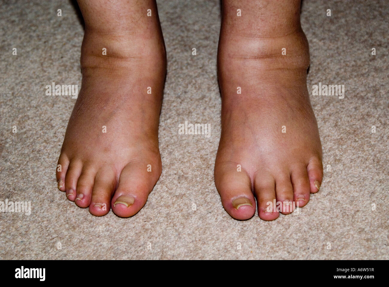 Swollen feet hires stock photography and images Alamy