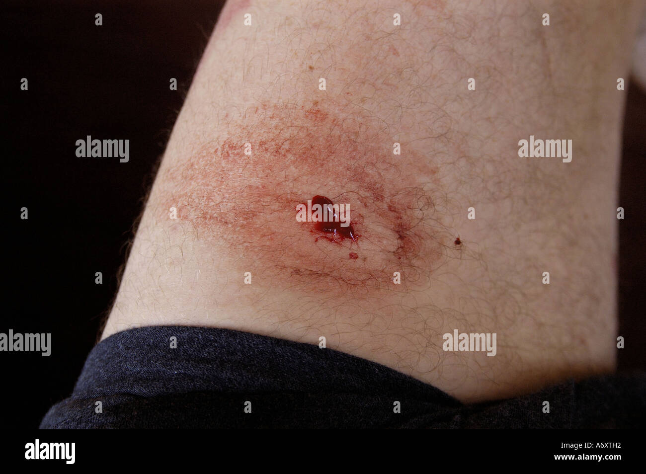 Leech bite hires stock photography and images Alamy