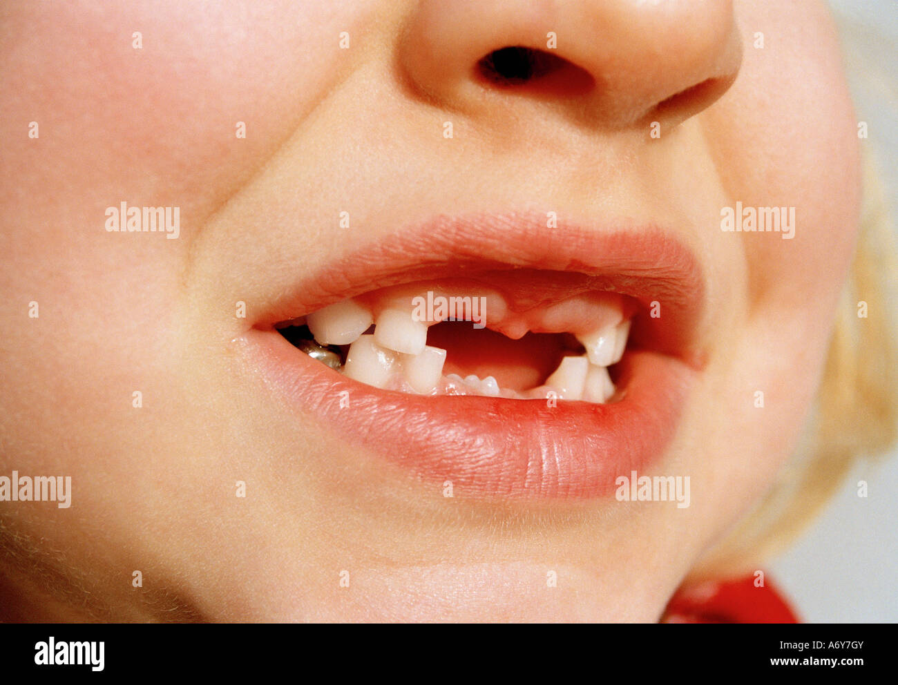 Close up of a young girl with missing teeth Stock Photo