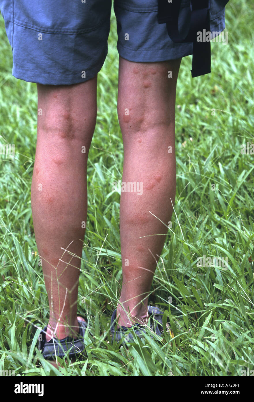 Woman with mosquito bitten legs Oahu Hawaii Stock Photo: 6684256 ...