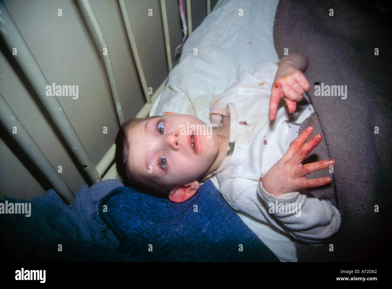 Disbled orphan in bed Romania Stock Photo