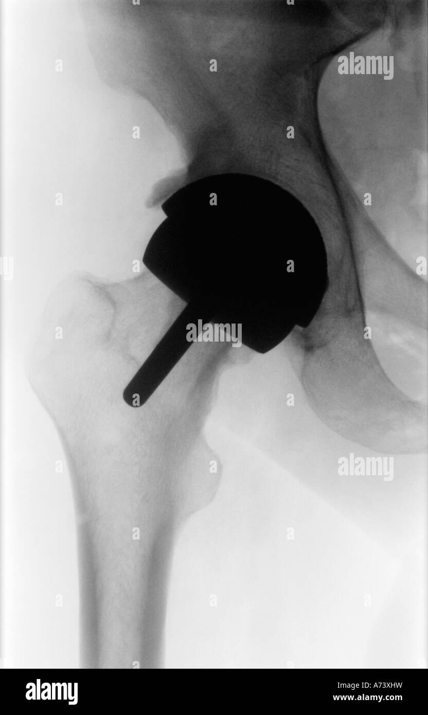 X ray Photograph of Hip showing Birmingham Hip Replacement Prosthesis