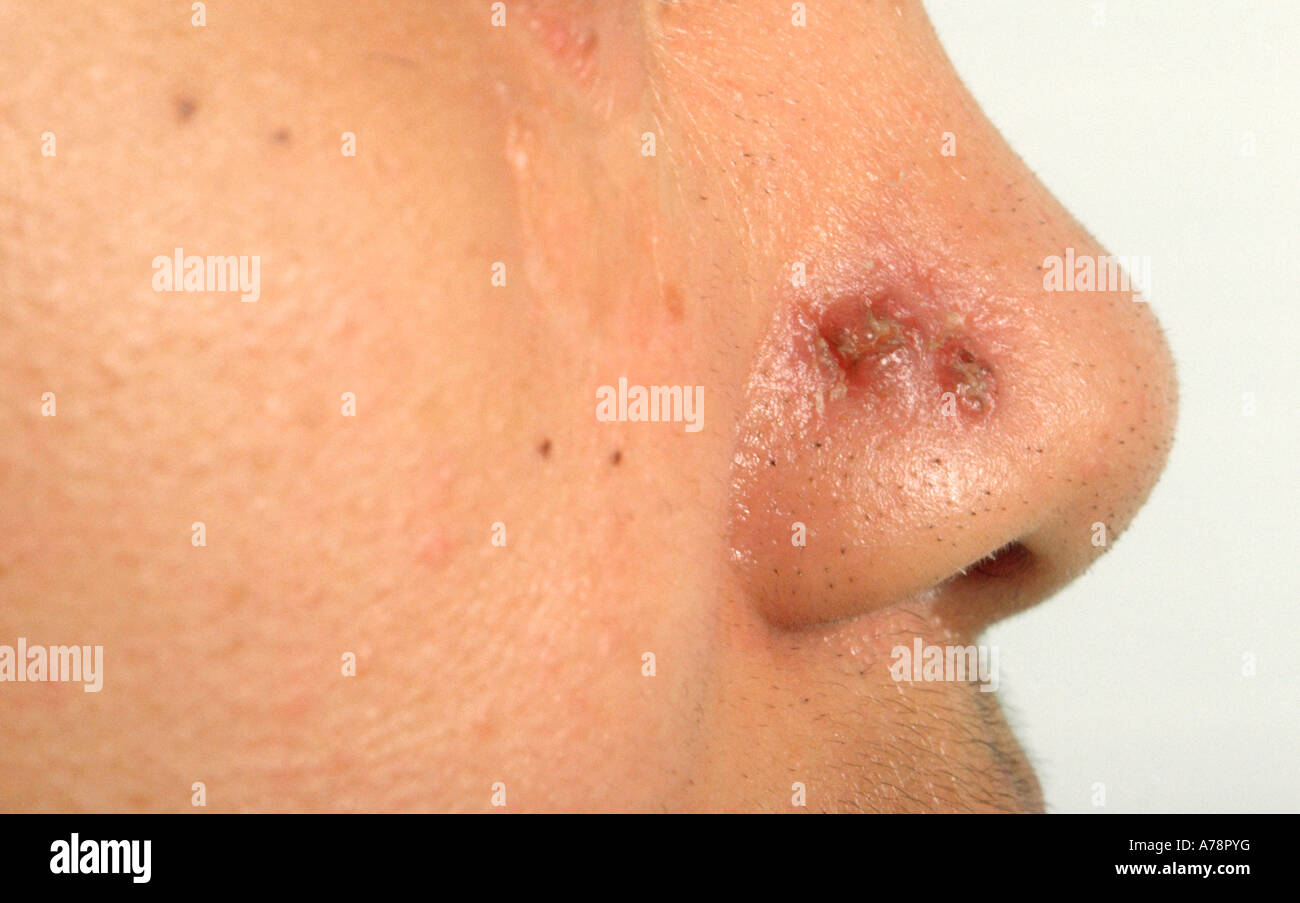 Lupus vulgaris Stock Photo