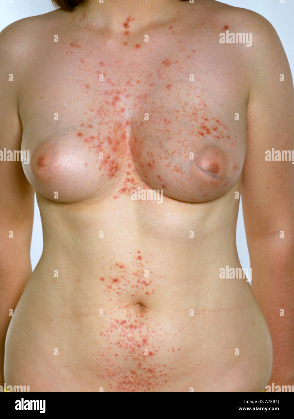 Dermatitis herpetiformis Stock Photo