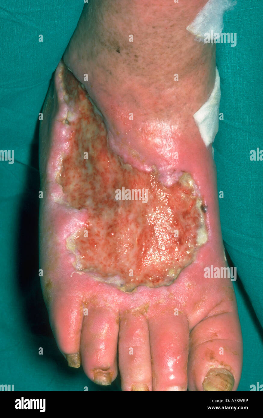 VENOUS ULCER ON FOOT Stock Photo