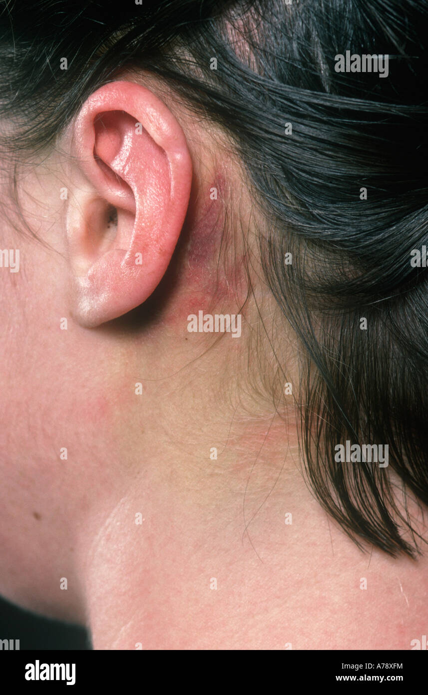 Battle's sign is skin discolouration due to extravasation of blood into the subcutaneous tissue behind the ear and over the mast Stock Photo
