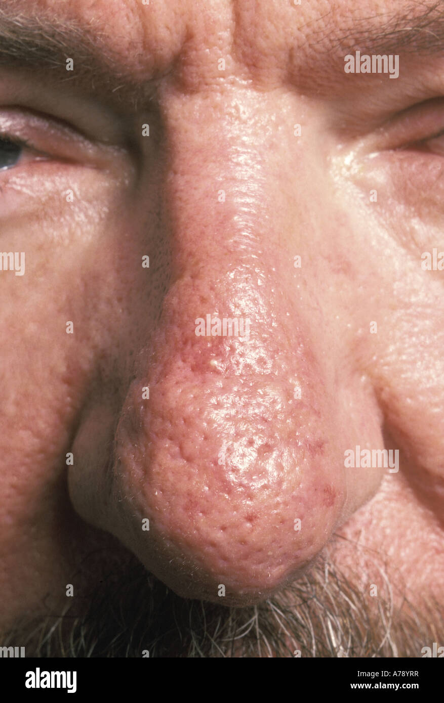 ROSACEA Stock Photo