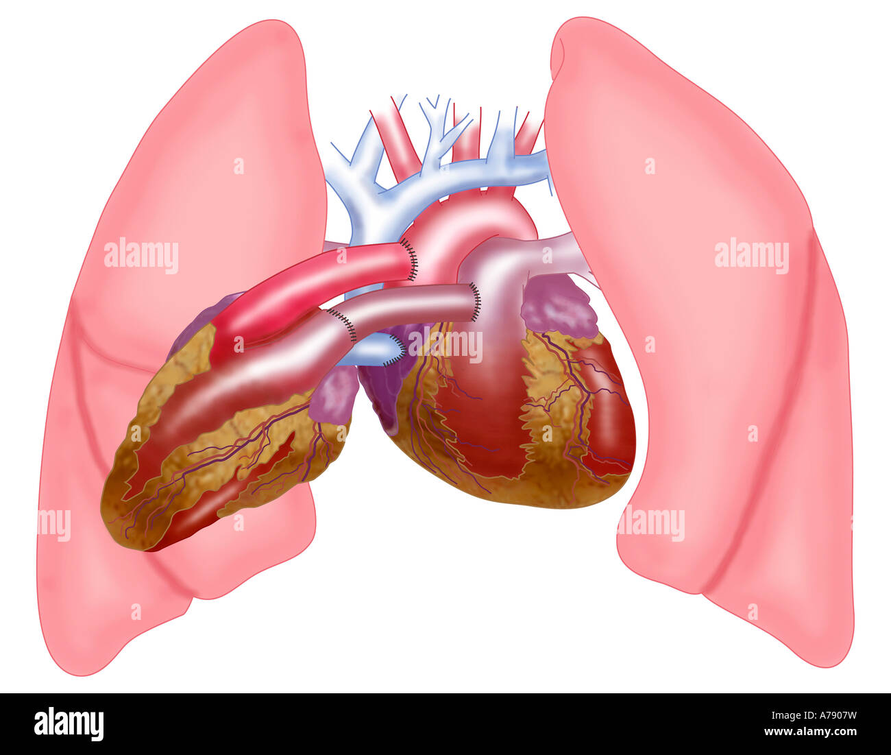 ILLUSTRATION - PIGGY BACK HEART TRANSPLANT Stock Photo