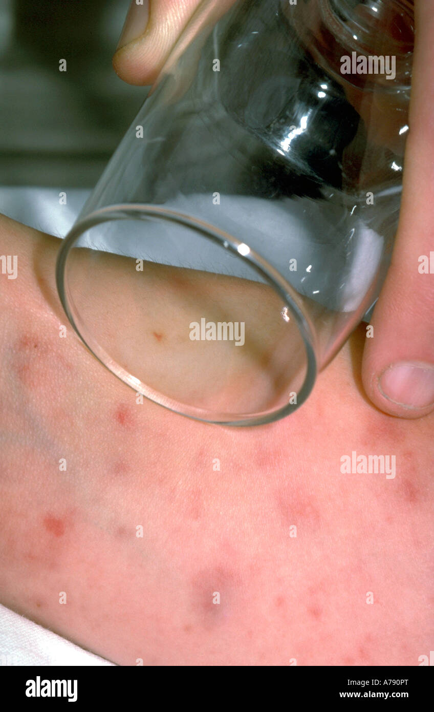 A photograph showing a purpuric rash being tested for meningitis. Stock Photo