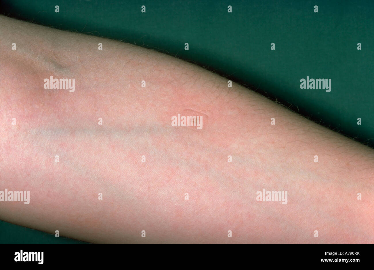 The Heaf test is a skin test performed in order to determine whether or not a person is immune to tuberculosis. Stock Photo