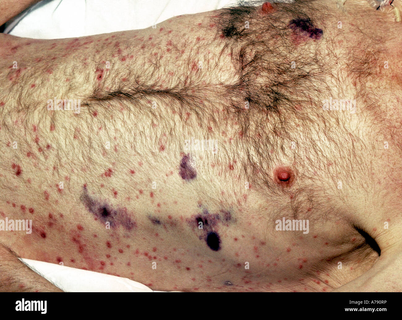 A photograph of a male HIV positive patient with disseminated Mycobacterium avium-intracellulare (MAI) infection Stock Photo