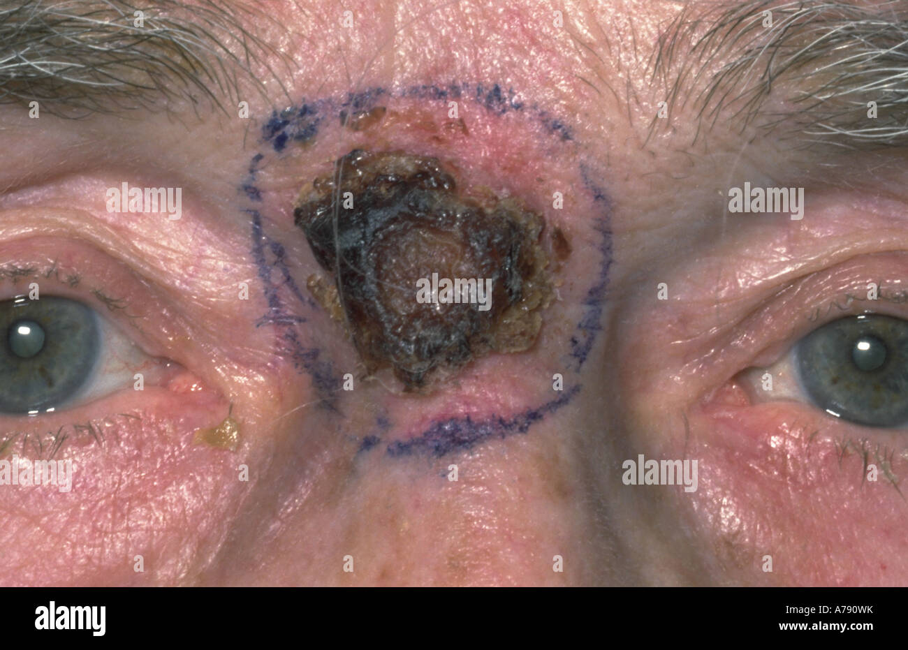 A photograph a female with a basal cell carcinoma, also called a rodent ulcer, on the bridge of the nose Stock Photo