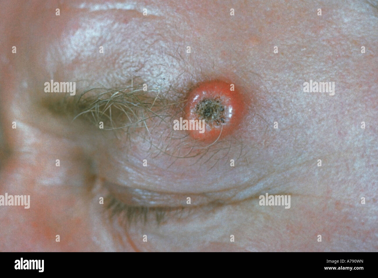 A photograph of a male with a molluscum sebaceum lesion, also called a keratocanthoma Stock Photo