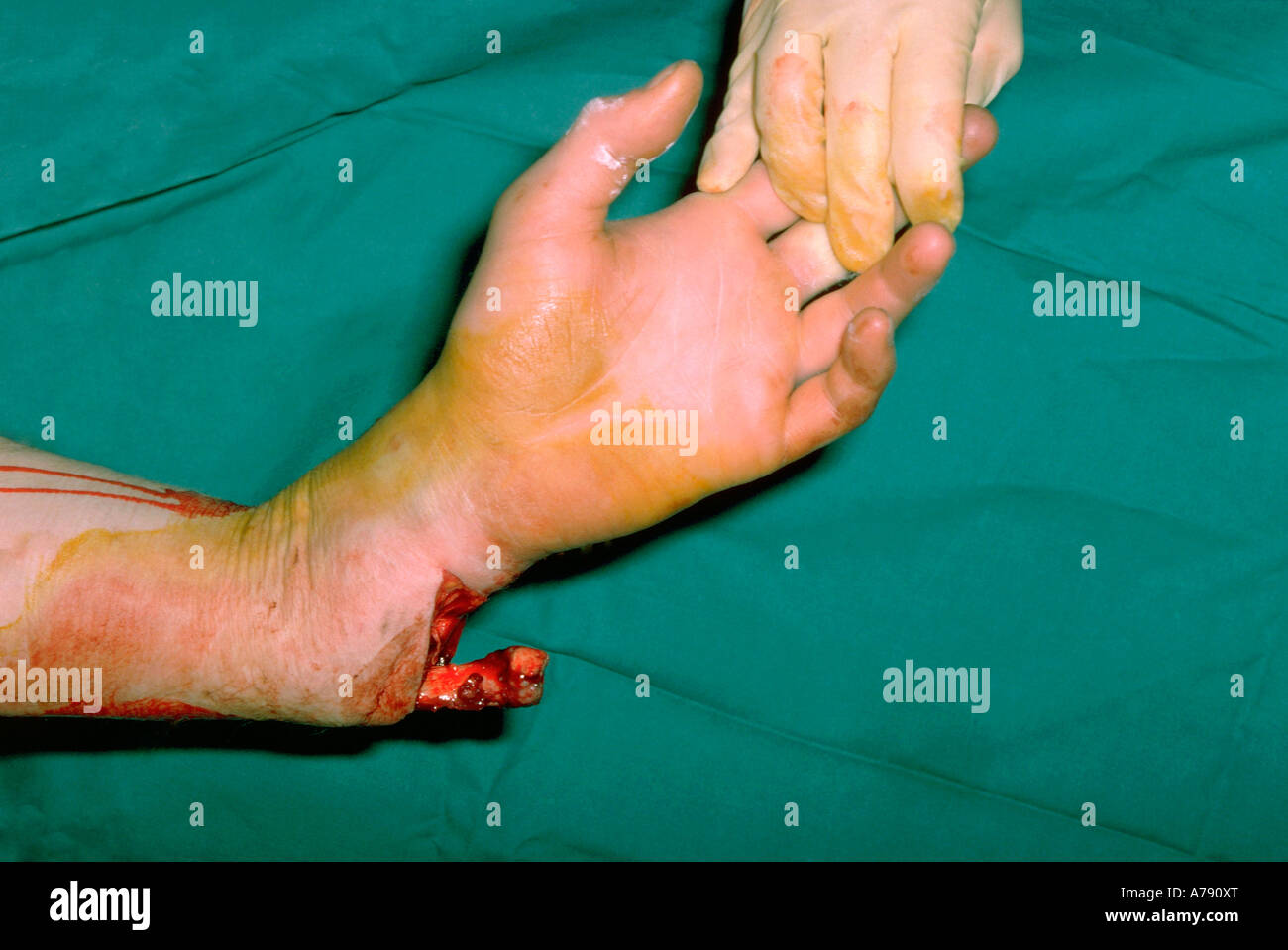 Compound Fracture High Resolution Stock Photography and Images - Alamy