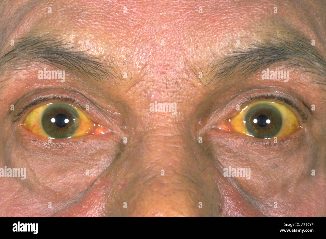 A photograph of a male with jaundice due to primary biliary cirrhosis Stock Photo