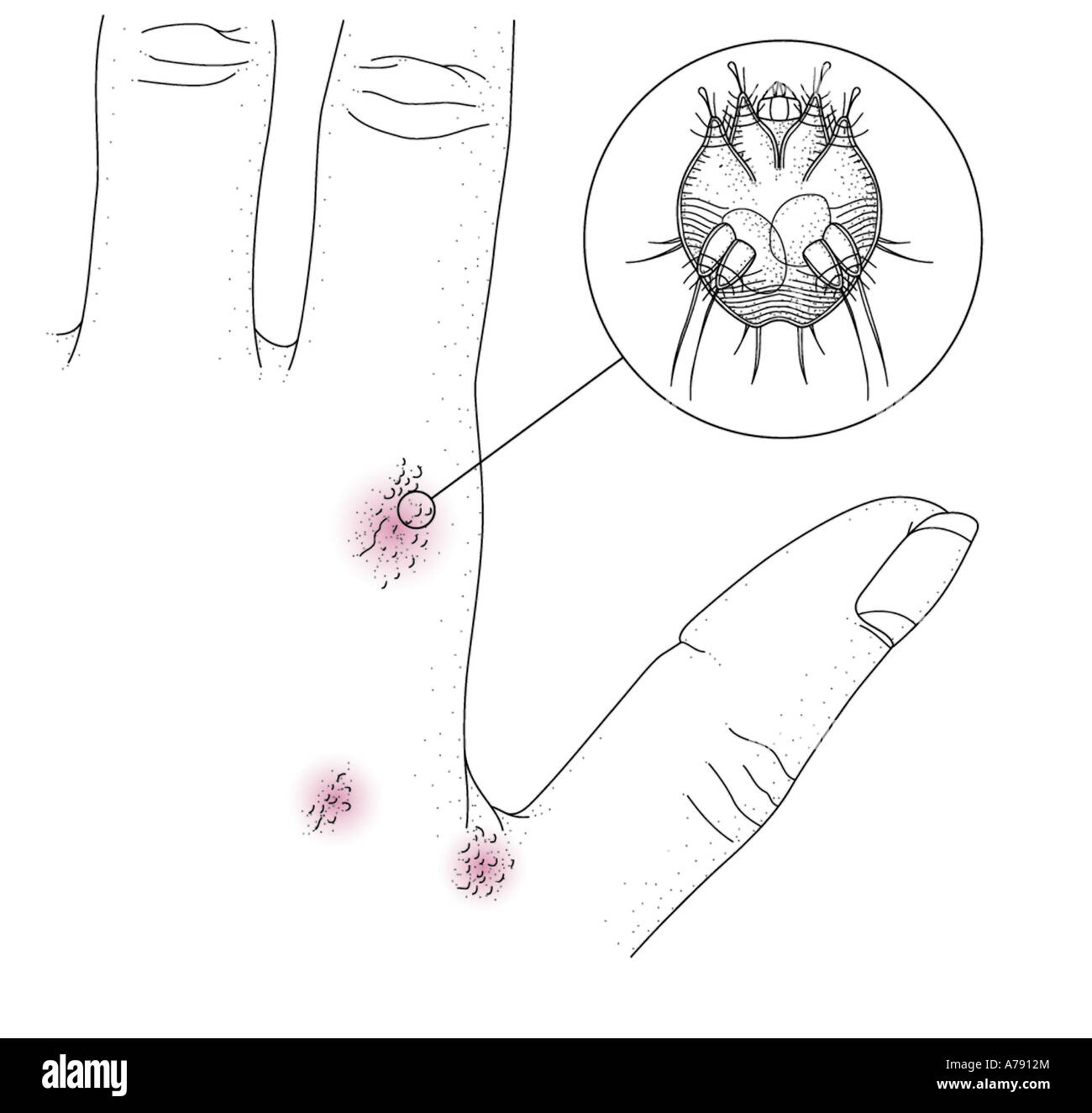 An illustration showing scabies bites to the hand and a close up detail of the scabies mite, sarcoptes scabiei. Stock Photo