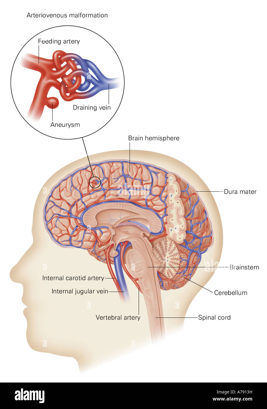 An illustration of the skull and brain showing an arteriovenous malformation. Stock Photo