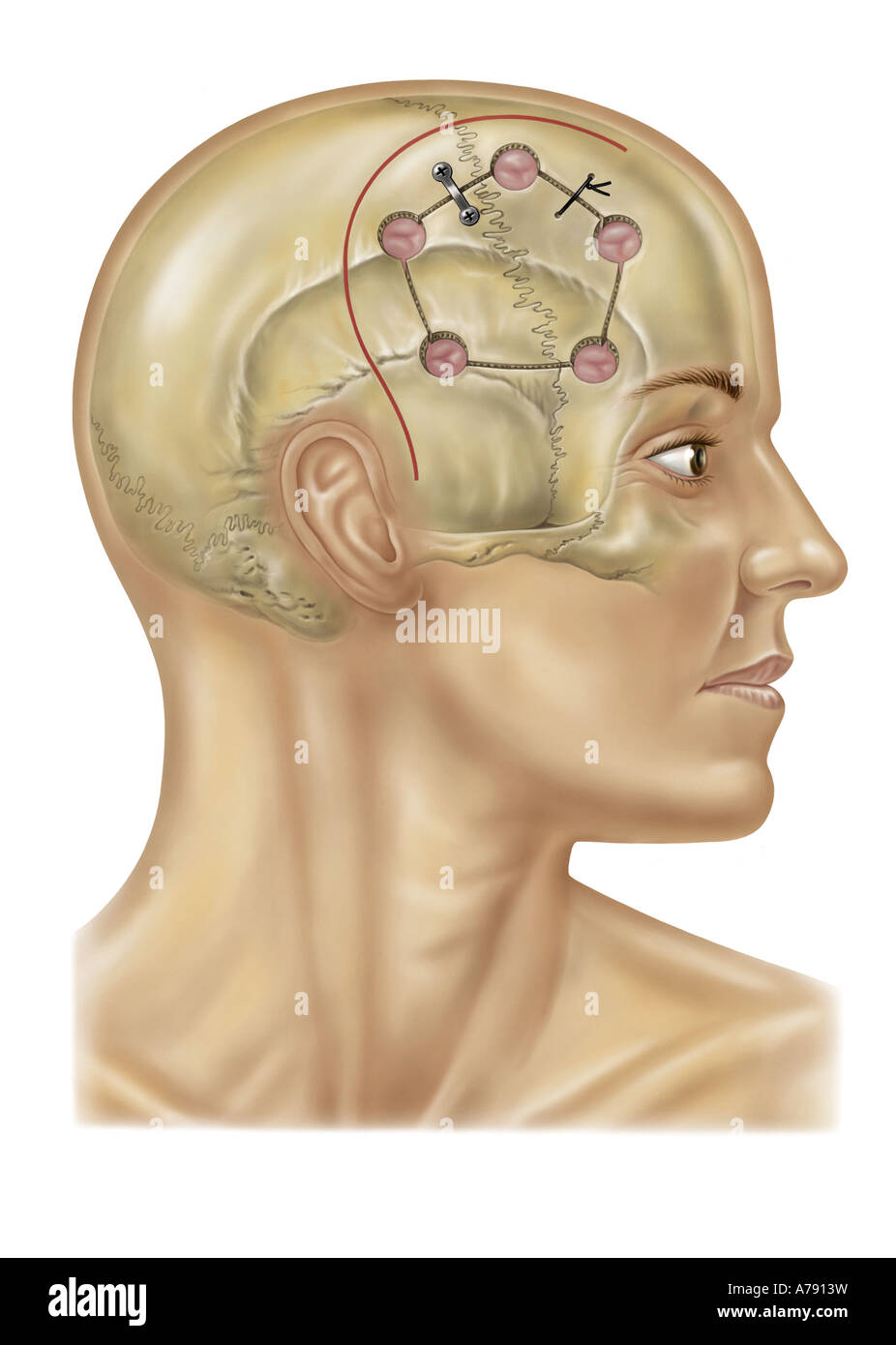 An illustration showing a craniotomy. Stock Photo