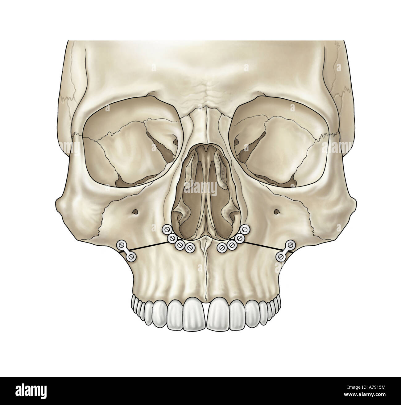 An illustration showing facial fracture repair Stock Photo