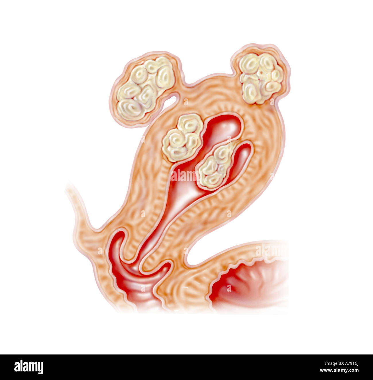 An illustration showing uterine fibroids Stock Photo