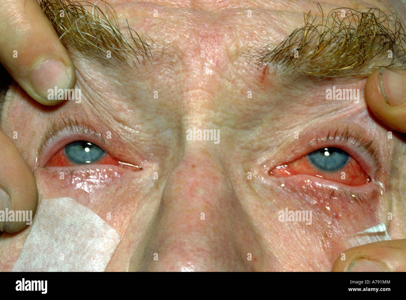 The white wall of the eye, called the sclera, is the eye's strong protective outer coat. Stock Photo