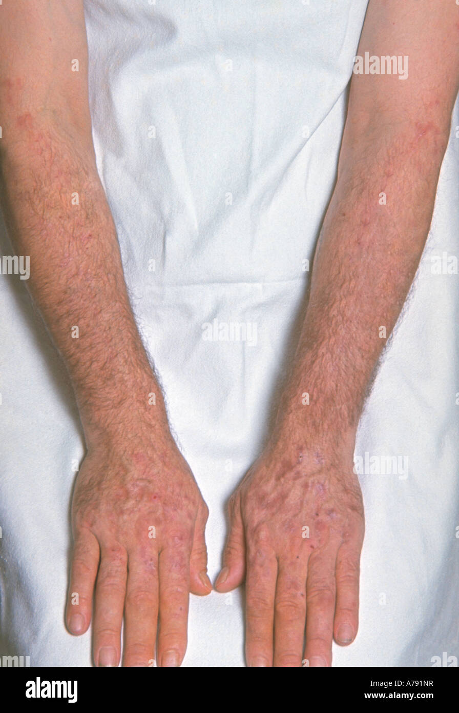 Pictures cutanea tarda porphyria Pictures cutanea tarda porphyria