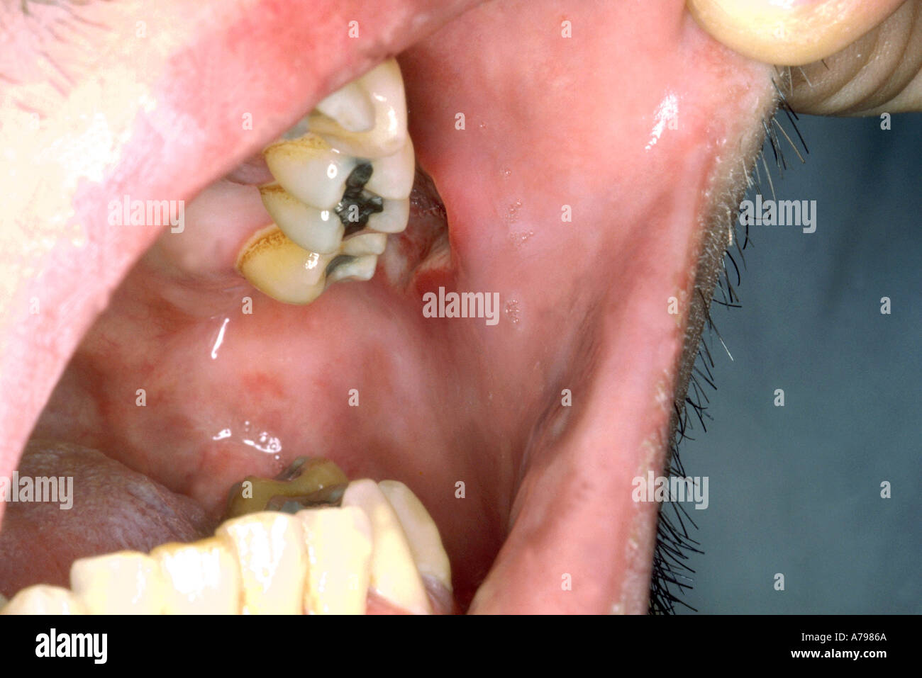 Mouth ulcers HIV Stock Photo
