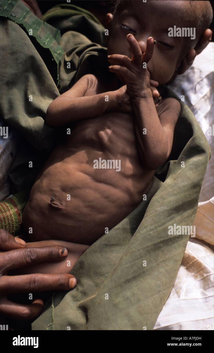 Ethiopia Fantalle ,Africa Malnourished baby Stock Photo