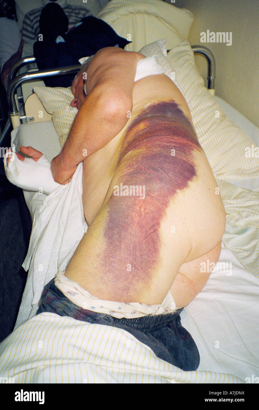 elderly man in a hospital after a motorbike accident, enormous hematoma in the lumbar region and on the thigh, hand fracture, brokened collarbone Stock Photo