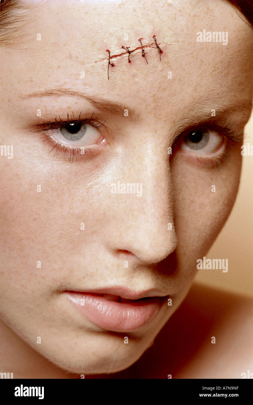 Freckles On Forehead , Everything you need to know about getting rid of ...
