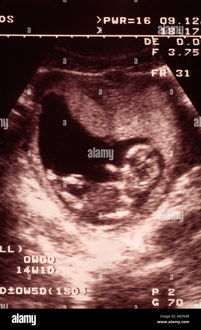 14 weeks human foetus ecography Stock Photo