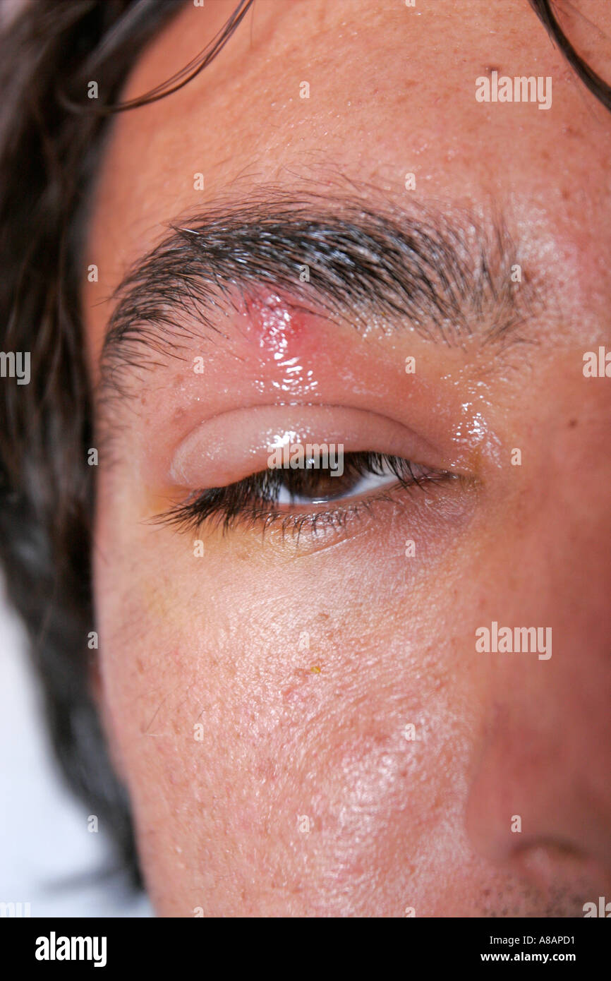 mosquito bite mosquito bite on man s eye a man s eye and brow Stock Photo 3931856 Alamy