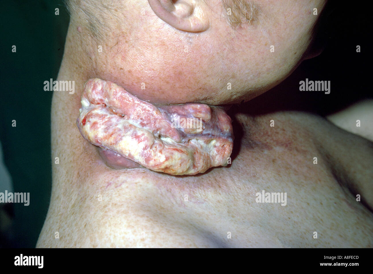 carcinoma of the neck Stock Photo