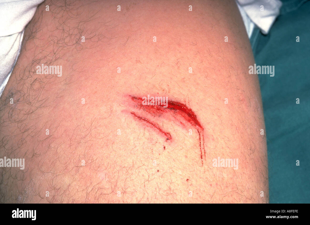 Laceration on thigh Stock Photo