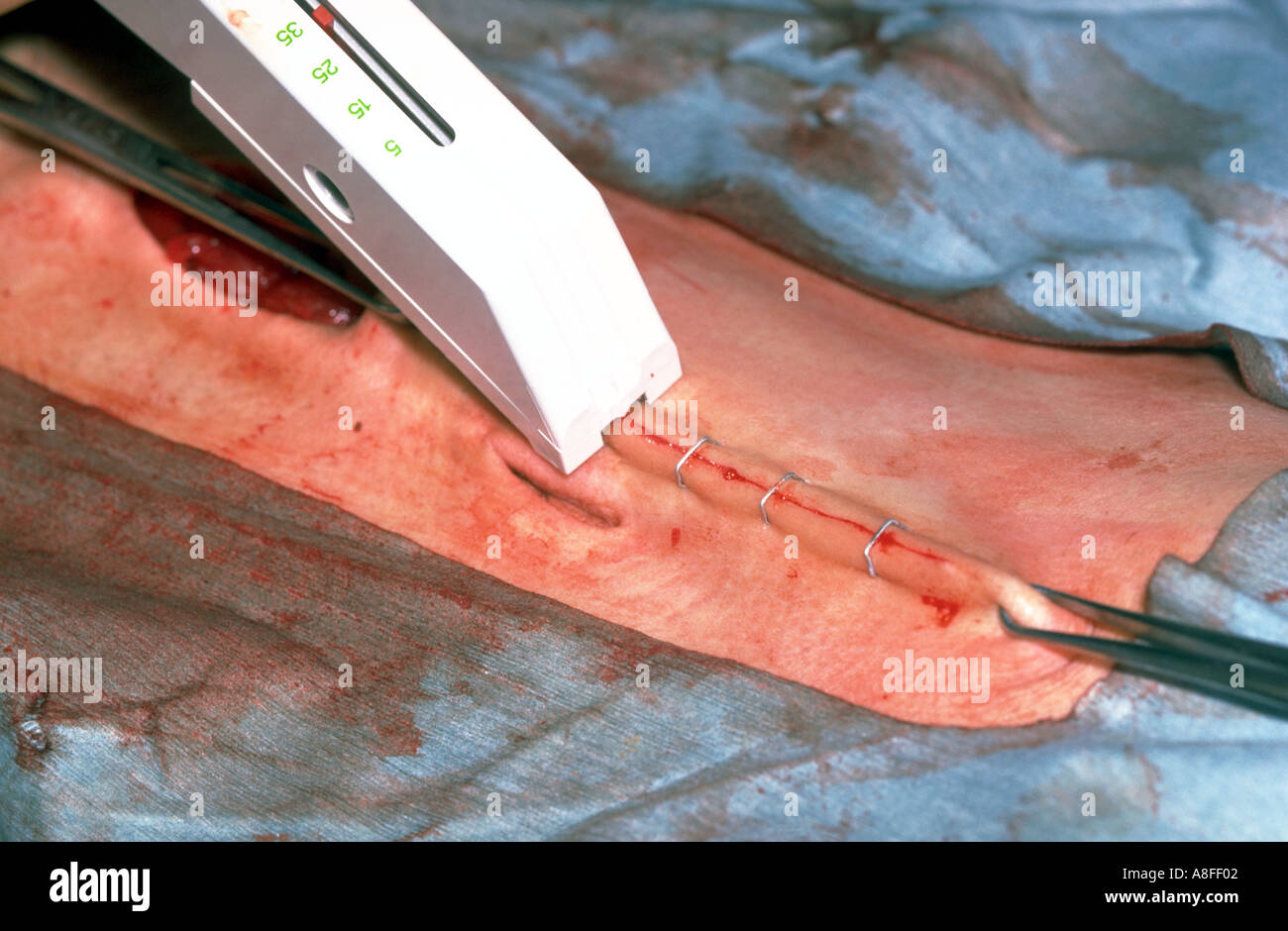 Surgical Staples Stock Photos & Surgical Staples Stock Images Alamy