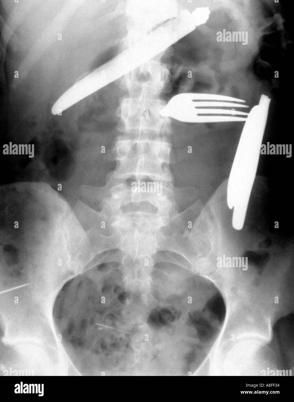 x ray Swallowed Foreign Bodies Stock Photo