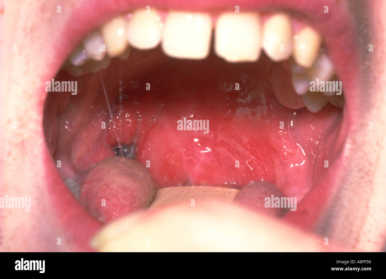 Quinsy Peritonsillar Abscess Stock Photo