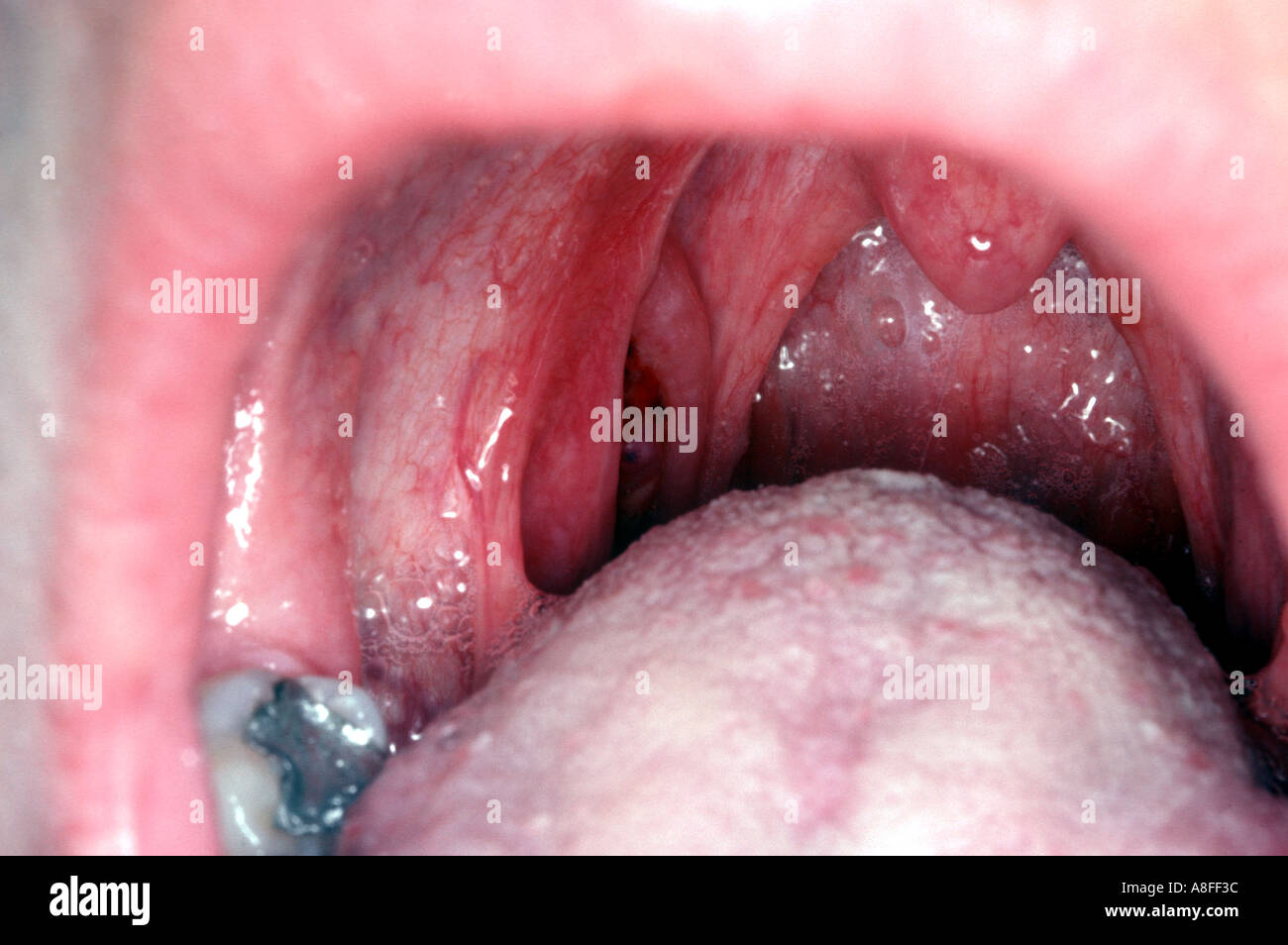 Oral candidiasis Stock Photo