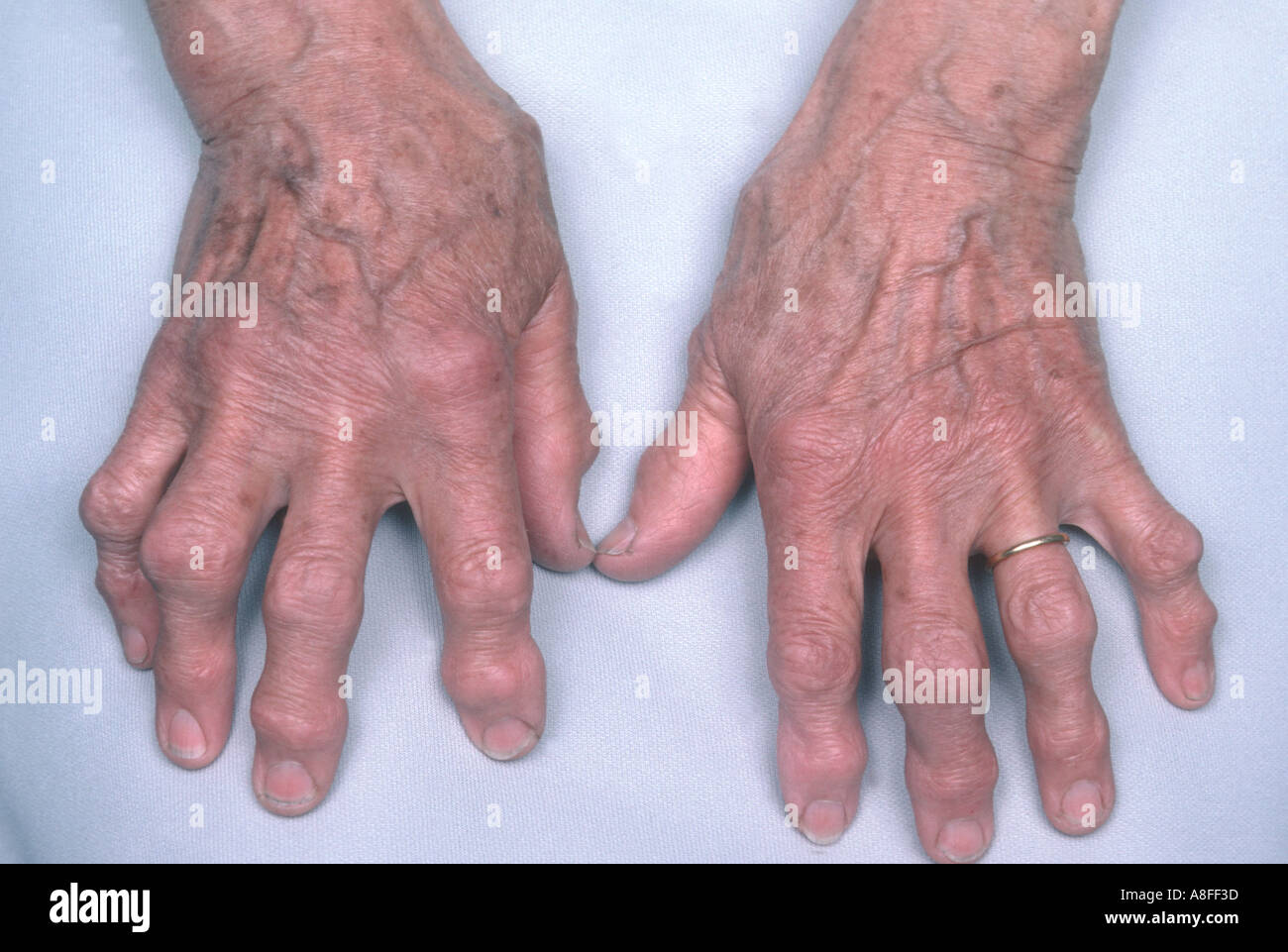 Osteoarthritis Hands High Resolution Stock Photography and Images Alamy