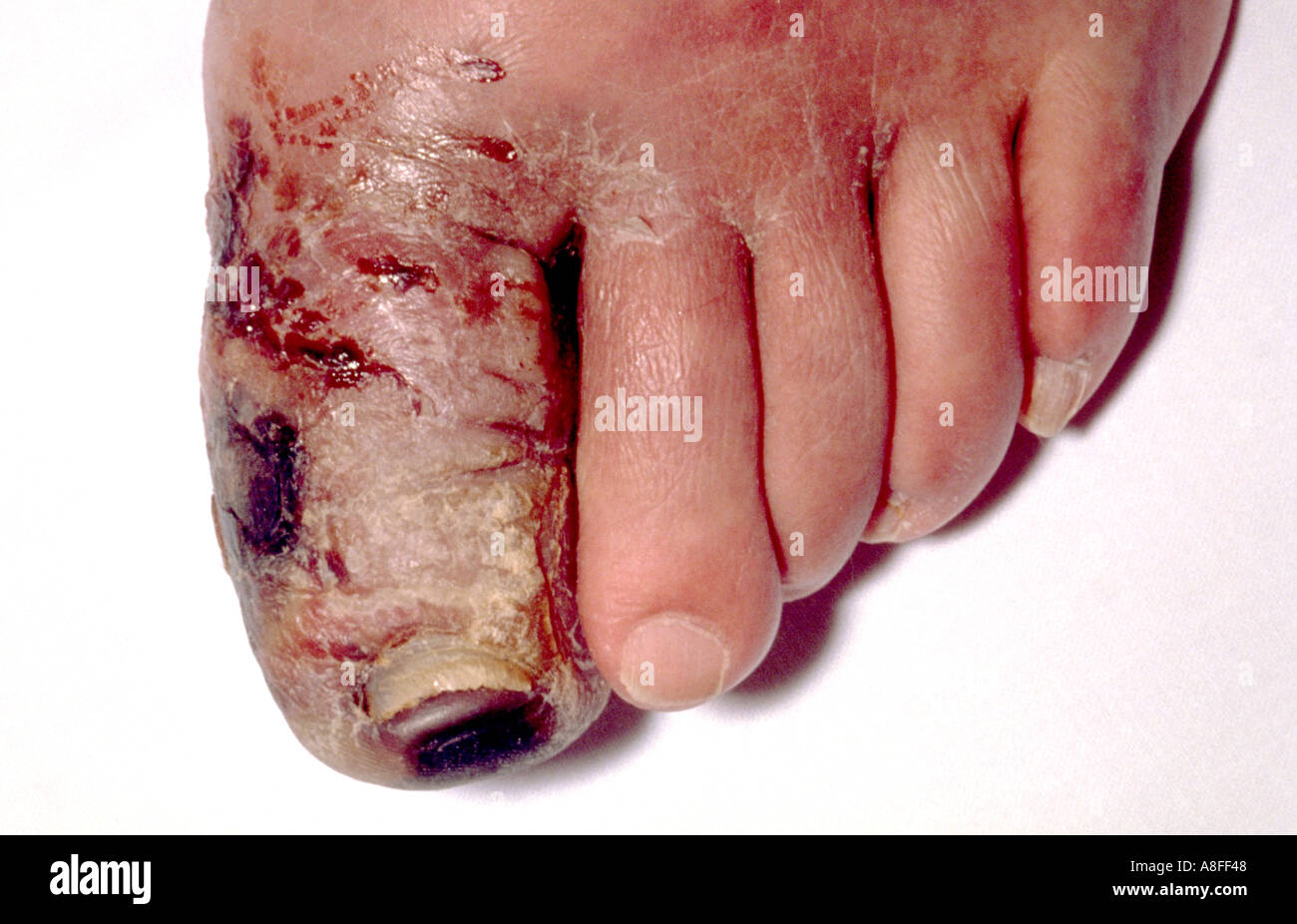 Gangrenous toe Stock Photo