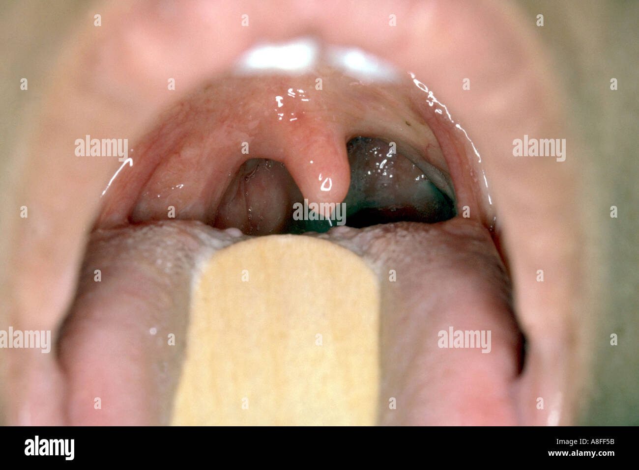 Retropharyngeal abscess Stock Photo Alamy