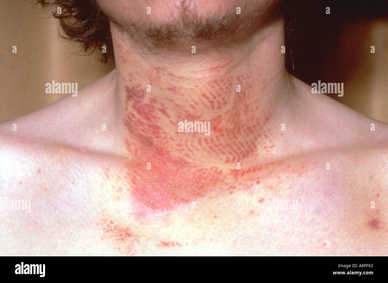 Strangulation marks on neck Stock Photo