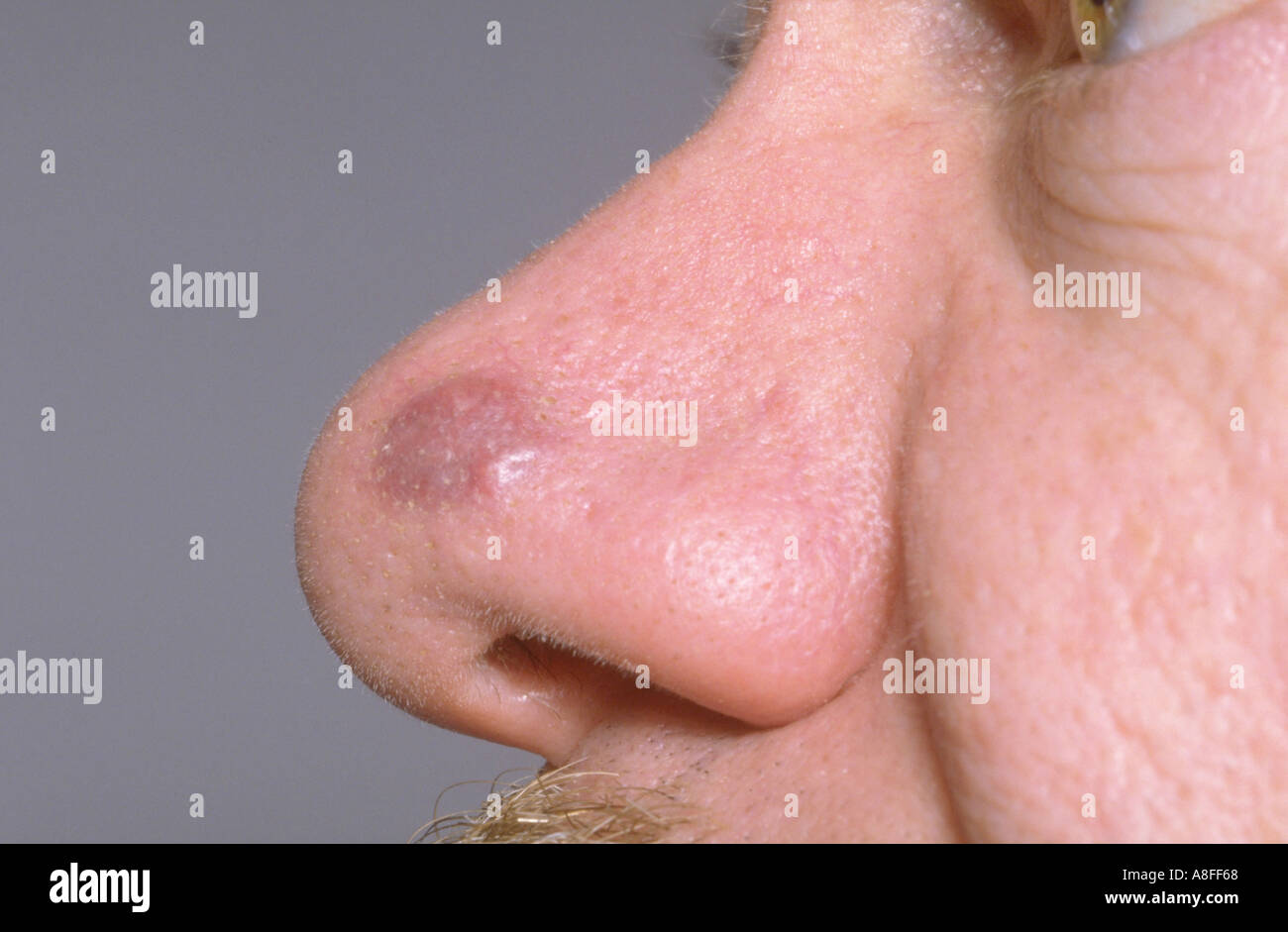 Kaposis sarcoma on nose Stock Photo