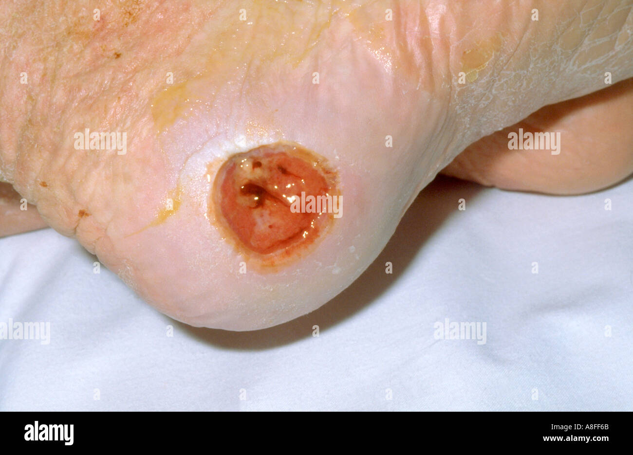 Pressure ulcer heel hi-res stock photography and images - Alamy